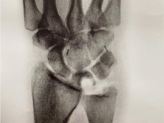 savannah cummins broken bone