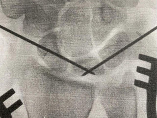 savannah cummins surgery